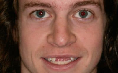 Reliable Dental Bridges Southlake TX