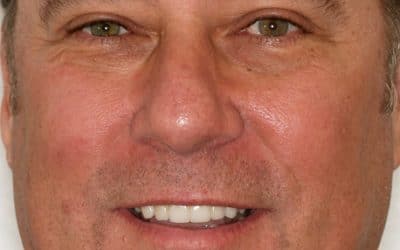 Affordable Tooth Replacement Bridges Southlake