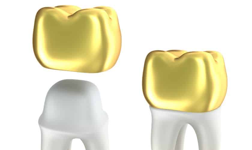 Dental Crowns Southlake | Family dentist in Southlake'